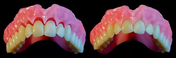 Abb. 21: Gingiva gedruckt aus DETAX (FREEPRINT Denture Base), Zahnkranz gedruckt aus Ruthinium B3 – beides im
1:1-Prozess (nicht Oversize). Links poliert, rechts nur die Supports abgebrochen, Klebespalt von 0,20 mm.