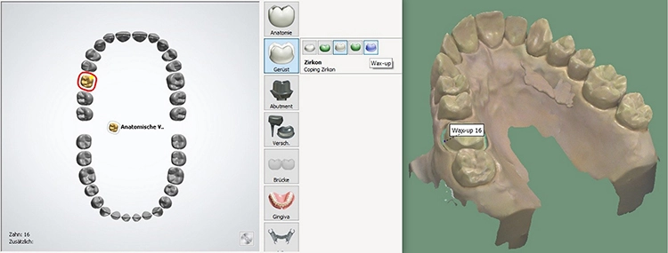 Abb. 21: Die in Wachs modellierte Krone als Wax-up im Auftrag anlegen und in der Designsoftware konstruieren.