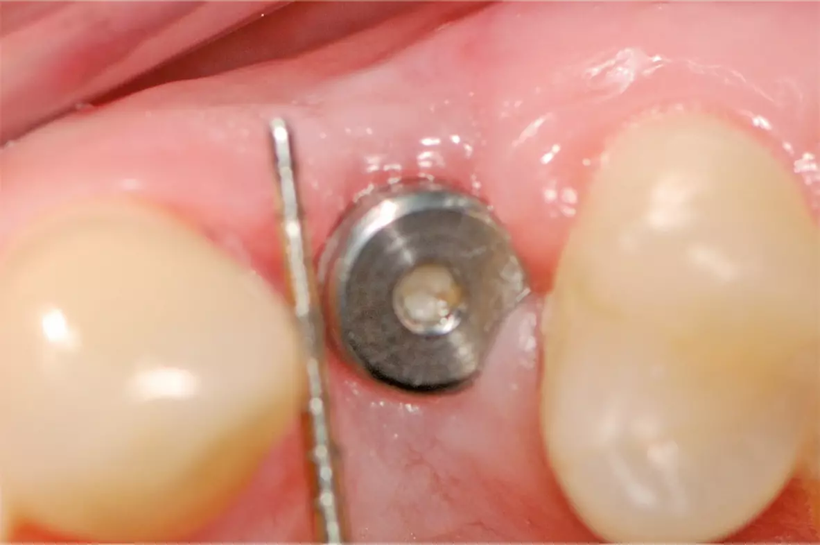 Abb. 21: Freilegung des Implantates in regio 24 drei Monate nach der Implantation.
