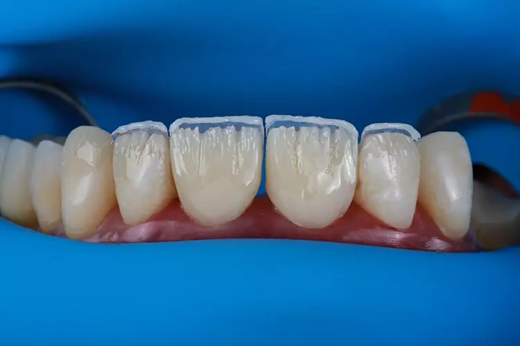 Abb. 21: Situation während des Auftragens des Komposits für die Dentinmasse
im inzisalen Drittel und die Schmelzmasse auf der gesamten labialen Fläche.