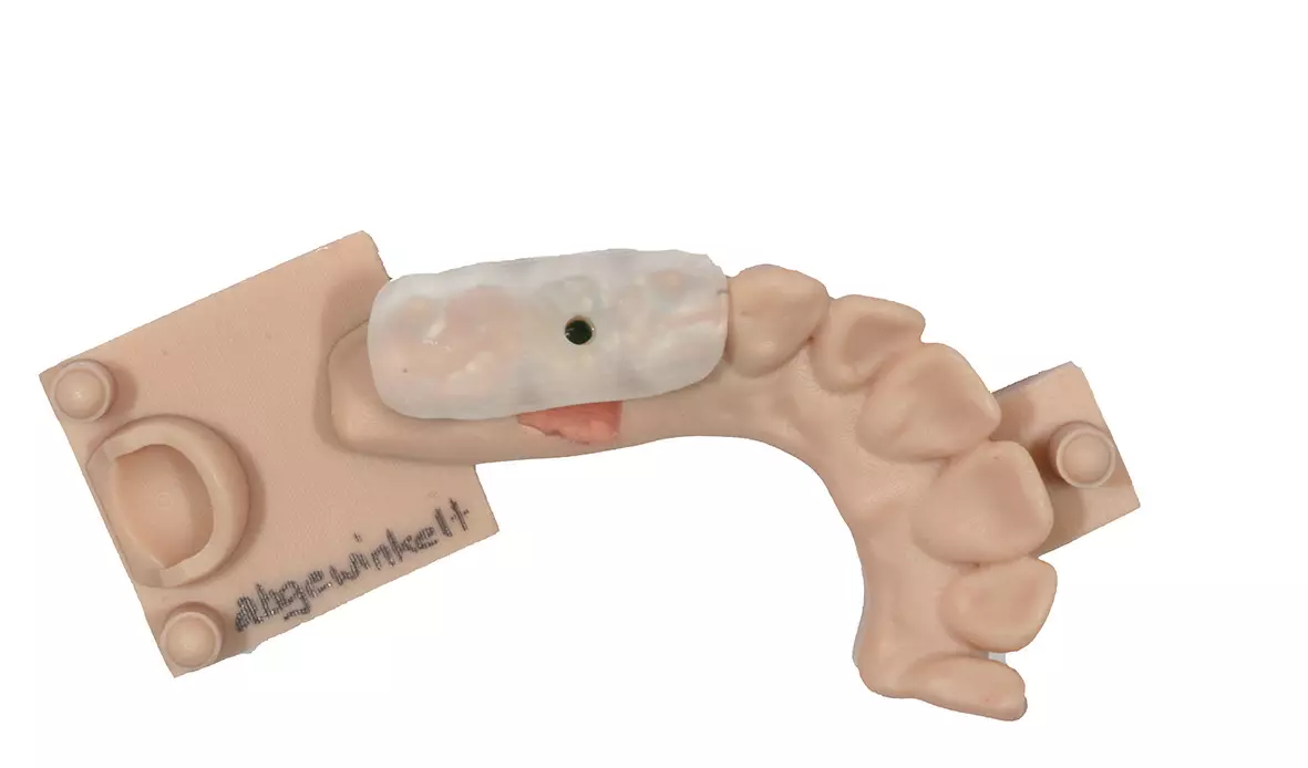 Abb. 21: Übertragungsschlüssel aus transparentem Kunststoff zur vereinfachten Übertragung der Implantatkrone in den Patientenmund.