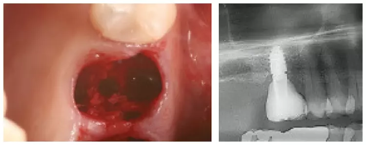 Abb. 21 und 22: Die Knochendichte entscheidet über den Implantatdurchmesser.