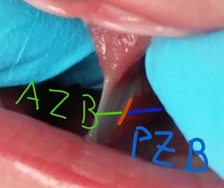 Abb. 22: Posteriorer Anteil des zu kurzen Zungenbandes (PZB).
