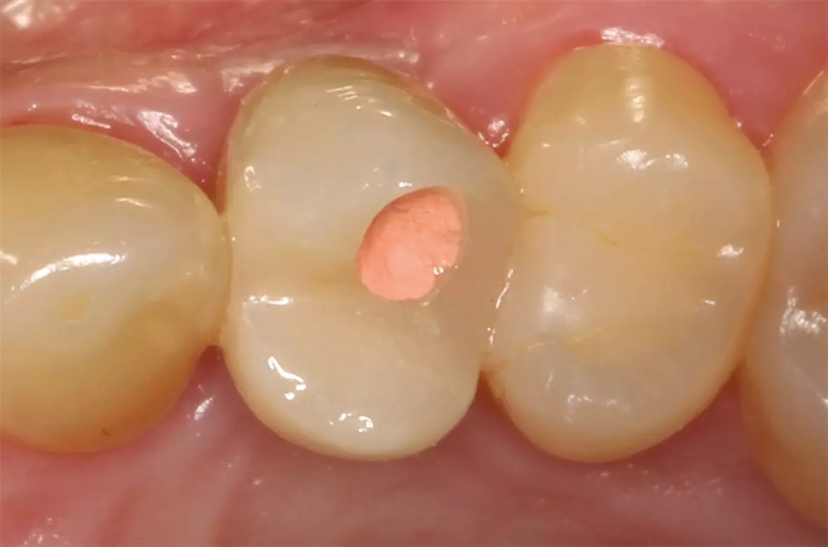 Abb. 22: Prothetische Versorgung des Implantates in regio 24.
