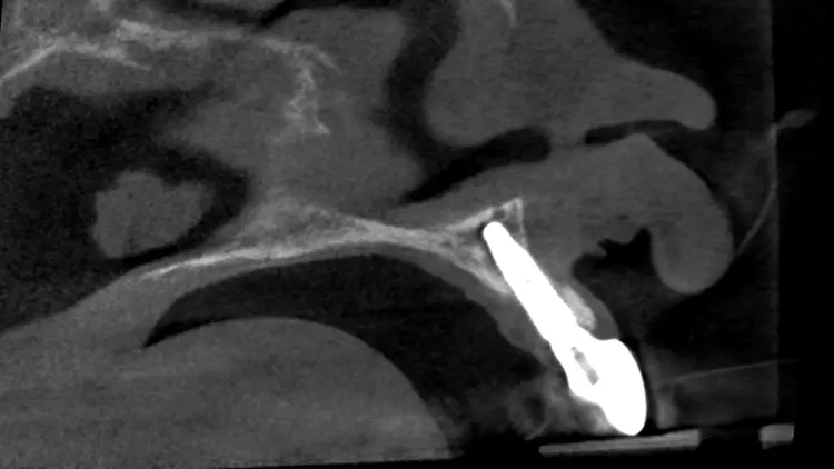 Abb. 22: CT postoperativ. Die ausgeprägte vestibuläre Konkavität des Hybrid-
Abutments bietet Platz für die Transplantatmaterialien und verhindert langfristig
eine Gewebeausdünnung.