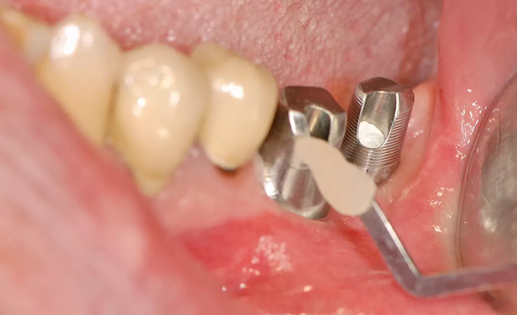 Abb. 22: Verschluss des Schraubenkanals mit Teflonband und Komposit.