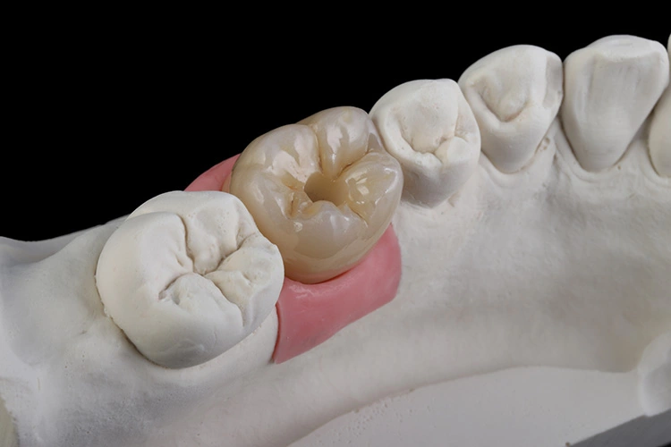 Abb. 22: Erste Passkontrolle an unverklebter Implantatkrone.