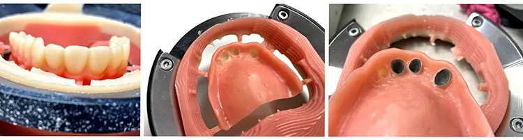 Abb. 23: Ivoclar Ivotion Bicolor Disc für eine OK-Cover-Denture-Prothese.