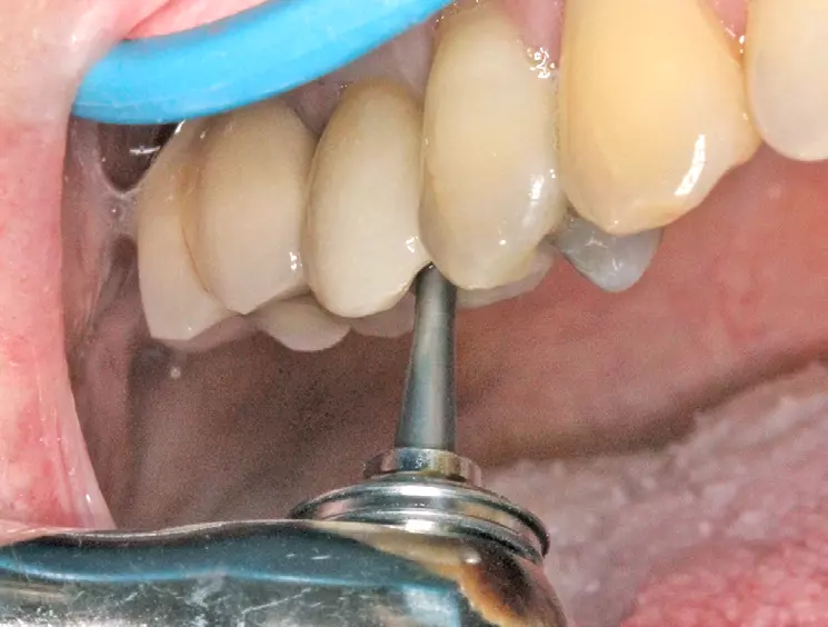 Abb. 23: Verschrauben des CustomBase-Abutments mit metallfreier Krone auf dem Implantat (Drehmoment 25 Ncm).