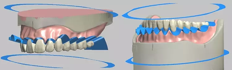 Abb. 24: Die blaue Shell Geometry in der 3Shape Software als visuelle Design-Hilfe.