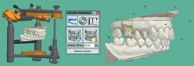 Abb. 24: Überprüfen der Bissrelation in der 3shape Software mittels virtuellen Artikulators.