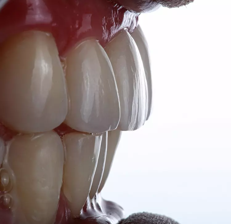 Abb. 24: Ästhetisches Endergebnis. Anatomie und Oberflächenstruktur der Kronen aus Grandio disc nach Charakterisierung mit Admira Fusion und FinalTouch.