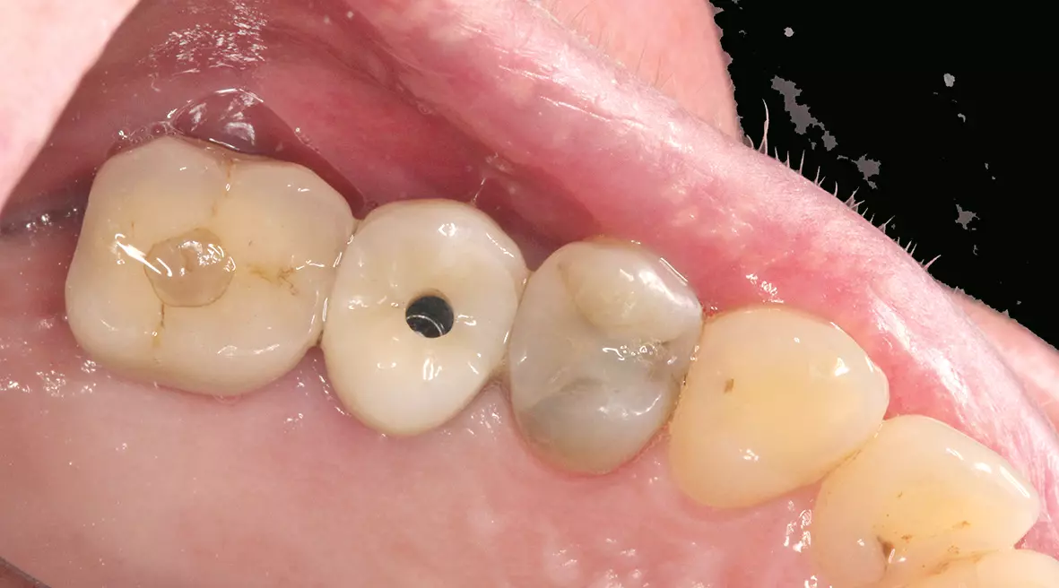 Abb. 24 Verschraubte Implantatkrone regio 15 vor dem Verschließen des Schraubkanals.