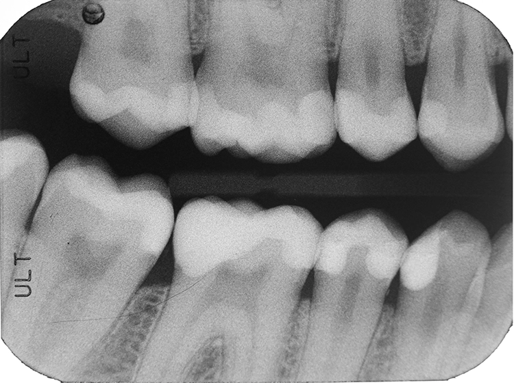 Abb. 24: Endergebnis nach 2 Wochen: Bissflügel-Röntgenaufnahme rechts.