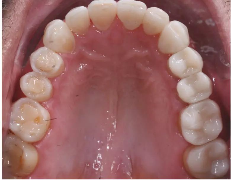 Abb. 25: Endergebnis: intraorale Ansicht von okklusal.