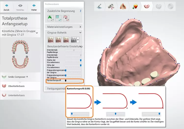 Abb. 26: Gingiva-Ästhetik in der 3Shape Software individuell designbar.
