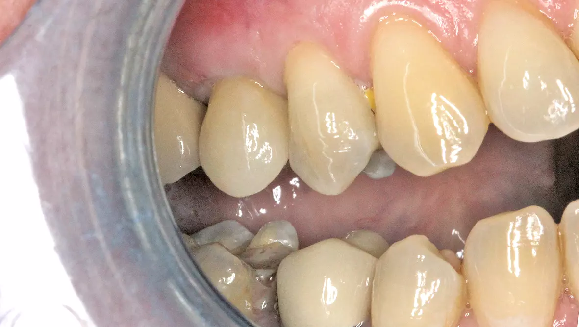 Abb. 26: Vestibuläre Ansicht des Ergebnisses: Die Implantatkrone 15 fügt sich unauffällig in die Zahnreihe ein.