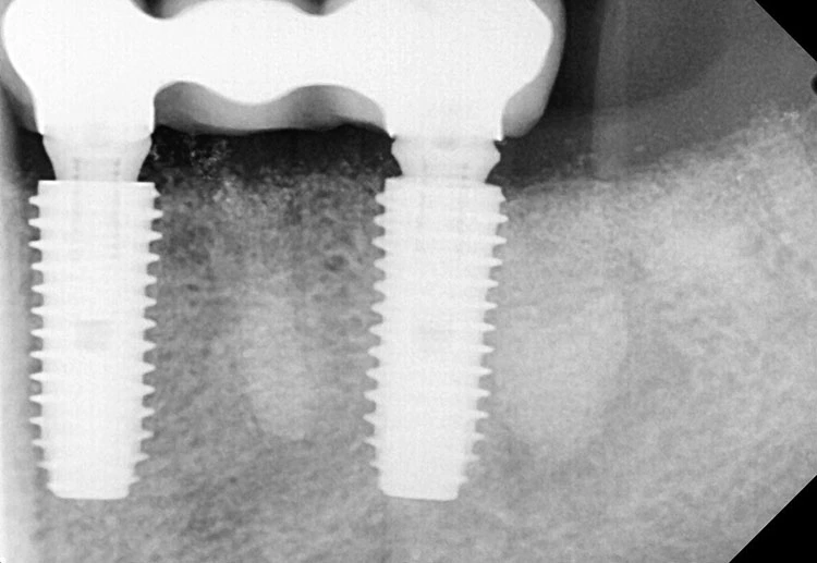 Abb. 27: Radiologische Untersuchung drei Monate nach Implantation.