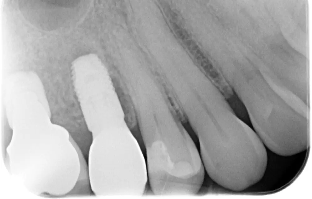 Abb. 27: Kontrollröntgenbild; Implantatkrone regio 15 mit patientenindividuellem Abutment (Atlantis) und metallfreier Krone. Die implantatprothetische Restauration regio 16 wurde im Jahr 2015 gefertigt.