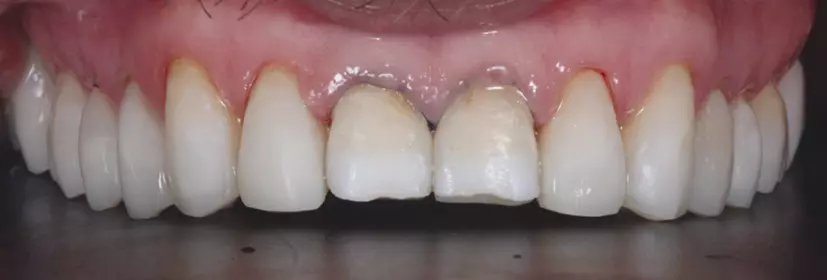 Abb. 27: Situation vor der Anfertigung von Veneers mit mittelviskosem Komposit (GrandioSO Flow, VOCO).