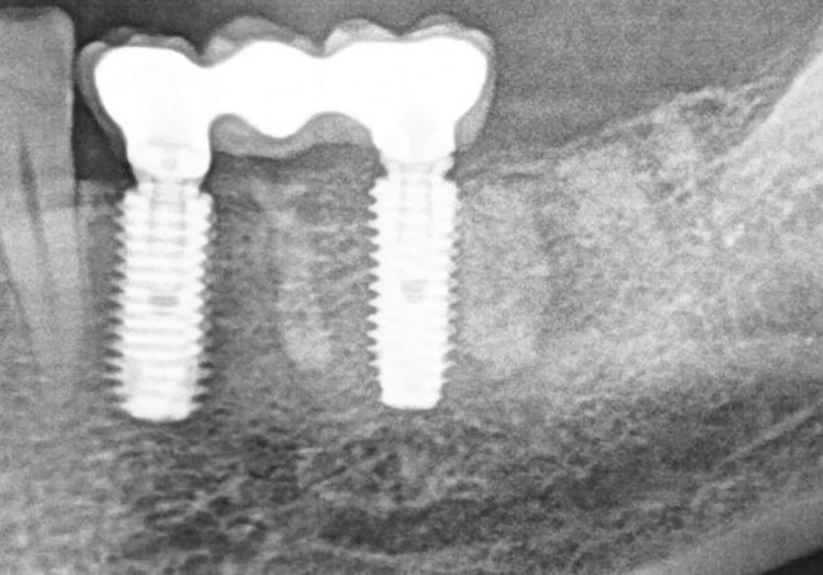 Abb. 28: Radiologische Untersuchung ein Jahr und vier Monate nach Implantation.
