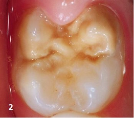 Abb. 2: Hypomineralisation an einem ersten bleibenden Molaren ohne diagnostizierbare Schmelzeinbrüche.