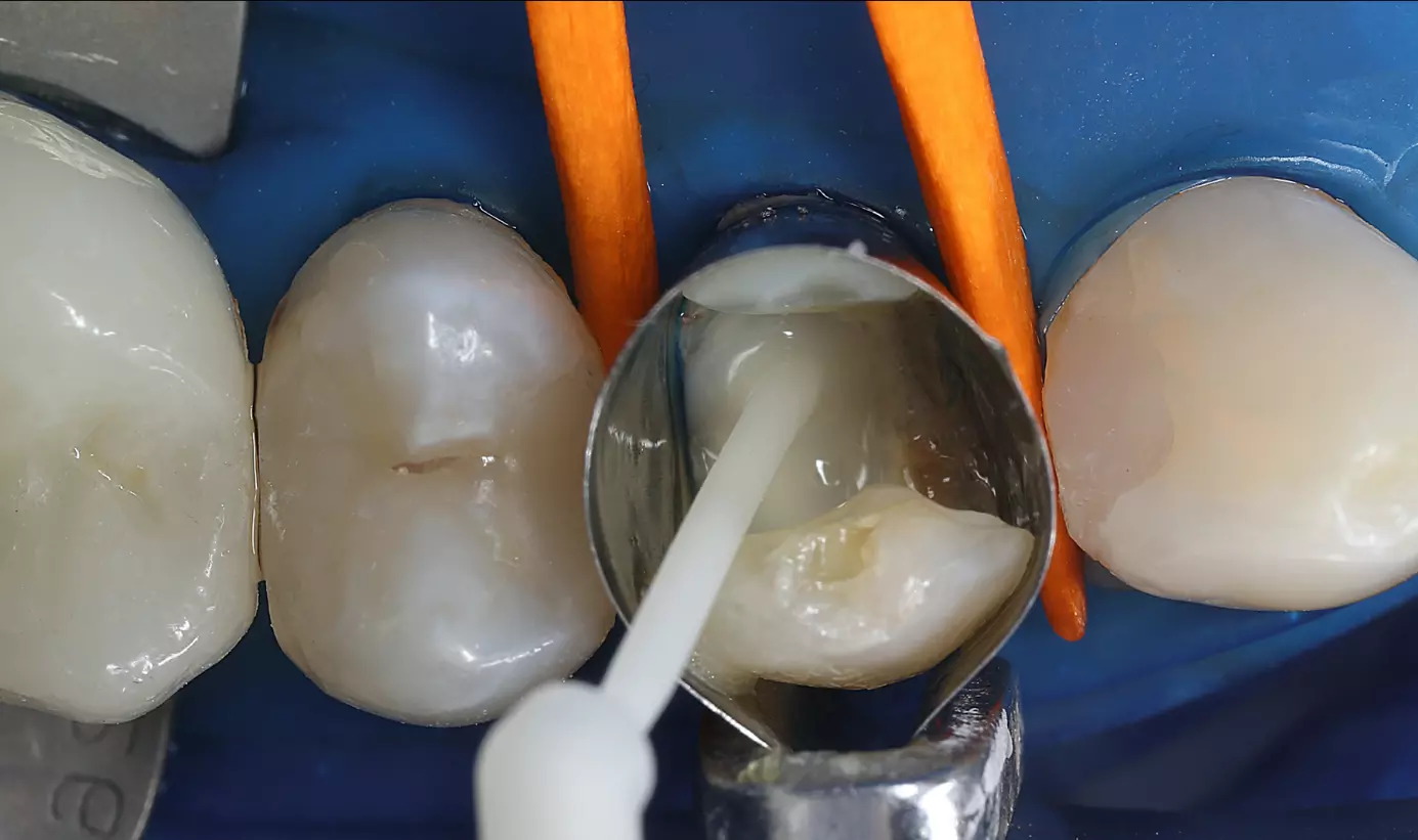 Angelegte Matrize und Kastenelevation mit Komposit (EverX Flow, GC).