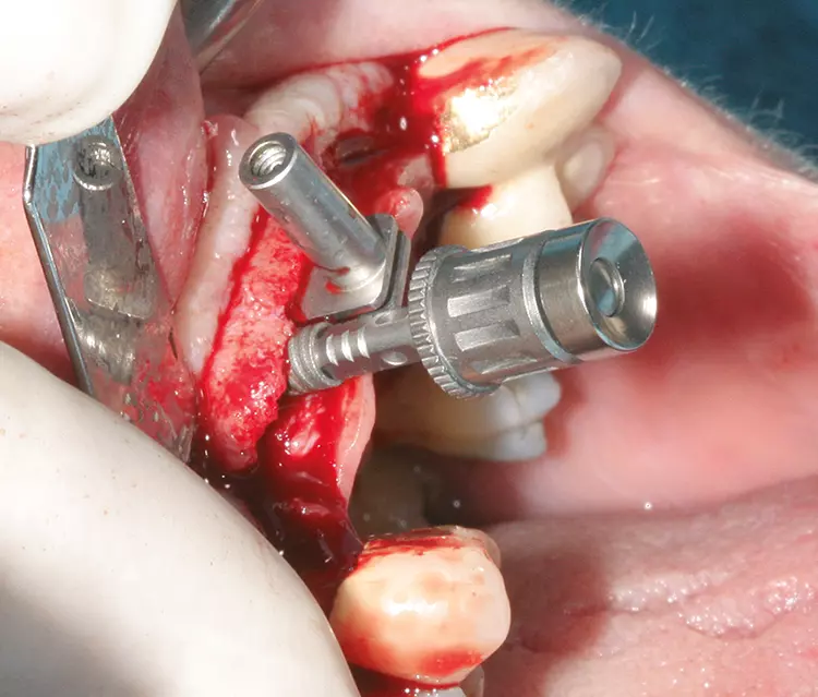Abb. 2: Setzen von drei durchmesserreduzierten Implantaten (Anthogyr Axiom BL PX, Ø 3,4 mm / Straumann-Gruppe) nach Knochenspreizung im Kieferkamm.