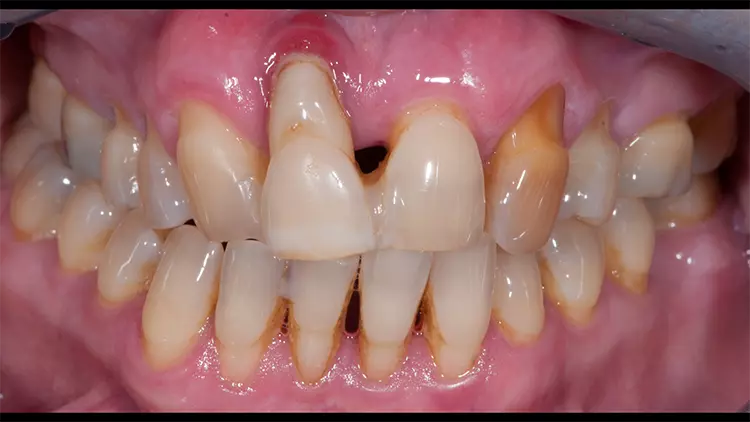 Abb. 2: Die intraorale Aufnahme verdeutlicht die ästhetisch und prothetisch insuffiziente Gebisssituation.