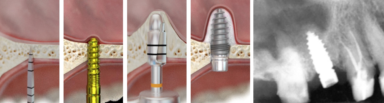 Abb. 2–6: Mit den Condensern (Champions-Implants) und mit linksdrehendem, abgeflachtem ø 3,7 mm Champions-Krestalbohrer hebt man die Membran erfolgreich und ohne Komplikationsgefahr an und führt Knochenersatzmaterial unterhalb der Membran ein. Anschließend wird ein Implantat mit Primärstabilität von 30 bis 40 Ncm inseriert. Auf dem Kontroll-Röntgenbild sieht man deutlich „die Wolke“ (EthOss, Vertrieb: Champions-Implants).
