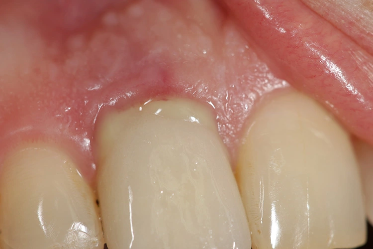 Abb. 2: Aufgrund einer eitrigen Entzündung zeigt sich die Gingiva an der Implantatversorgung von Zahn 11 geschwollen und entzündet.