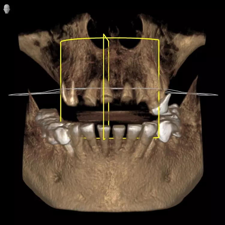 Abb. 2: DVT-Aufnahme und 3D-Planning der prothetischen Versorgung.