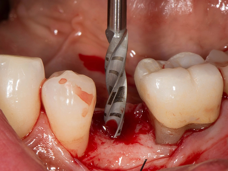 Abb. 2: Intraoperativer Situs während der Implantation. Der chirurgische Ablauf zur Anwendung von zweiteiligen Keramikimplantaten entspricht weitgehend dem klinischen Ablauf bei der Anwendung von herkömmlich verwendeten Titanimplantaten.