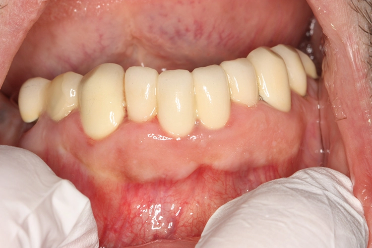 Abb. 2: Klinische Ausgangssituation mit breiter Gingiva und kurzen Kronen im Oberkiefer.