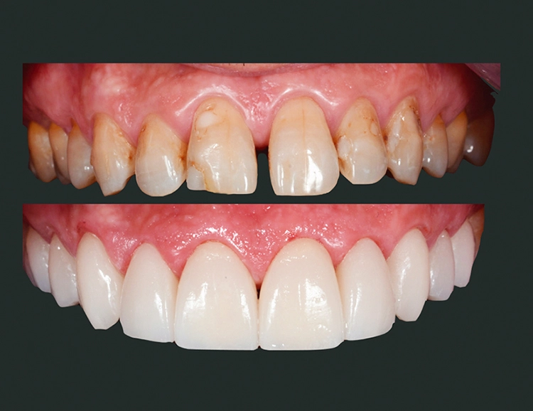 Vorher/Nachher: Abbildung der rein ästhetischen, minimalinvasiven Behandlung des Oberkieferbogens mit Veneers.
