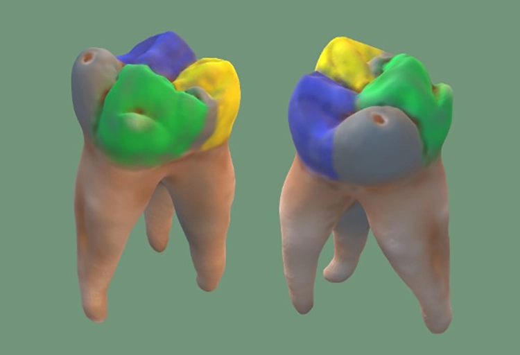 In der Software „Autodesk Meshmixer“ modifizierte Krone zum Wurzelzahn.