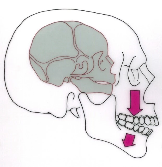 Abb. 2a: Muskuläre Anpassung der Mandibula an das dreidimensionale skelettale Wachstum des nasomaxillären Komplexes und der Oberkieferdentition [8,10–15].