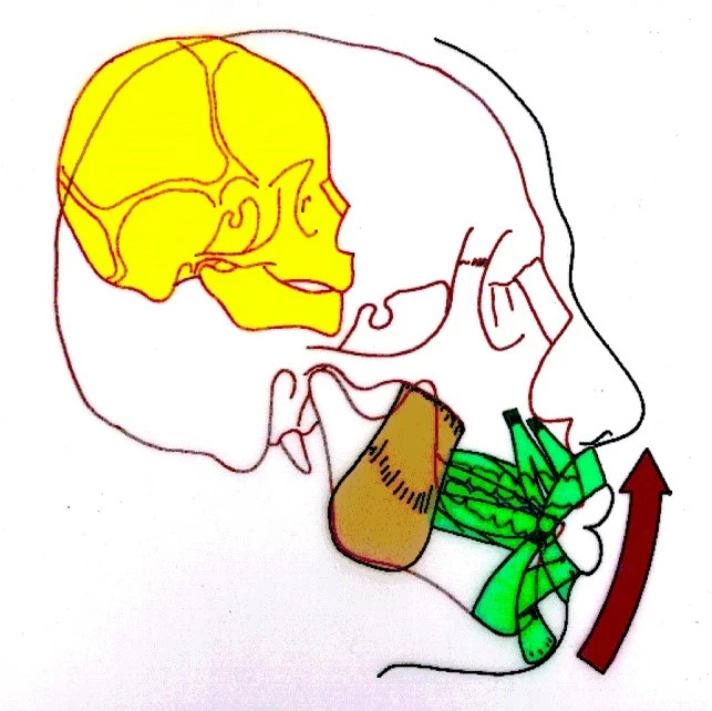 Abb. 2b: Muskuläre Anpassung der Mandibula an das dreidimensionale skelettale Wachstum des nasomaxillären Komplexes und der Oberkieferdentition [8,10–15].