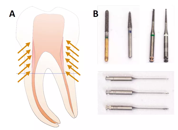 Abb. 3:
a) Primäre und sekundären Zugangskavität; die roten Bereiche entsprechen dem Dentinabtrag, der bei der Präparation der sekundären Zugangskavität und dem koronalen Preflaring erfolgt.
b) Instrumentarium: Neben dem vorsichtigen Einsatz diamantierter Schleifkörper sind auch überlange Rosenbohrer dem gezielten Dentinabtrag sehr dienlich.