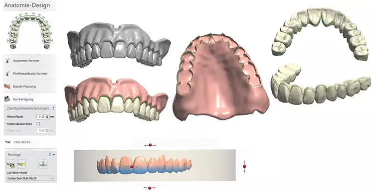 Abb. 30: „Copy Denture“ (Duplikatprothese) eines Oberkiefer-14ers.