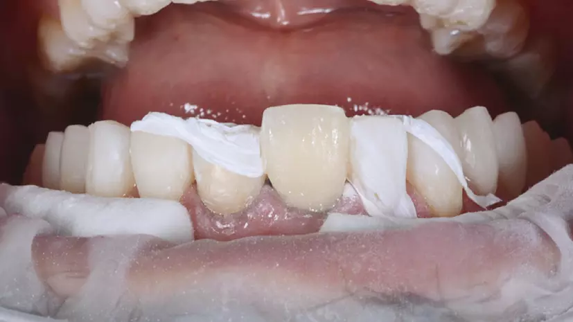 Abb. 33: Endergebnis: Veneer aus GrandioSO Flow.
