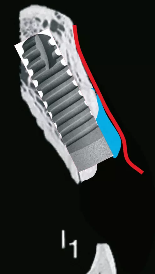 Abb. 3: Schematische Darstellung der Applikation von easy-graft (blau).