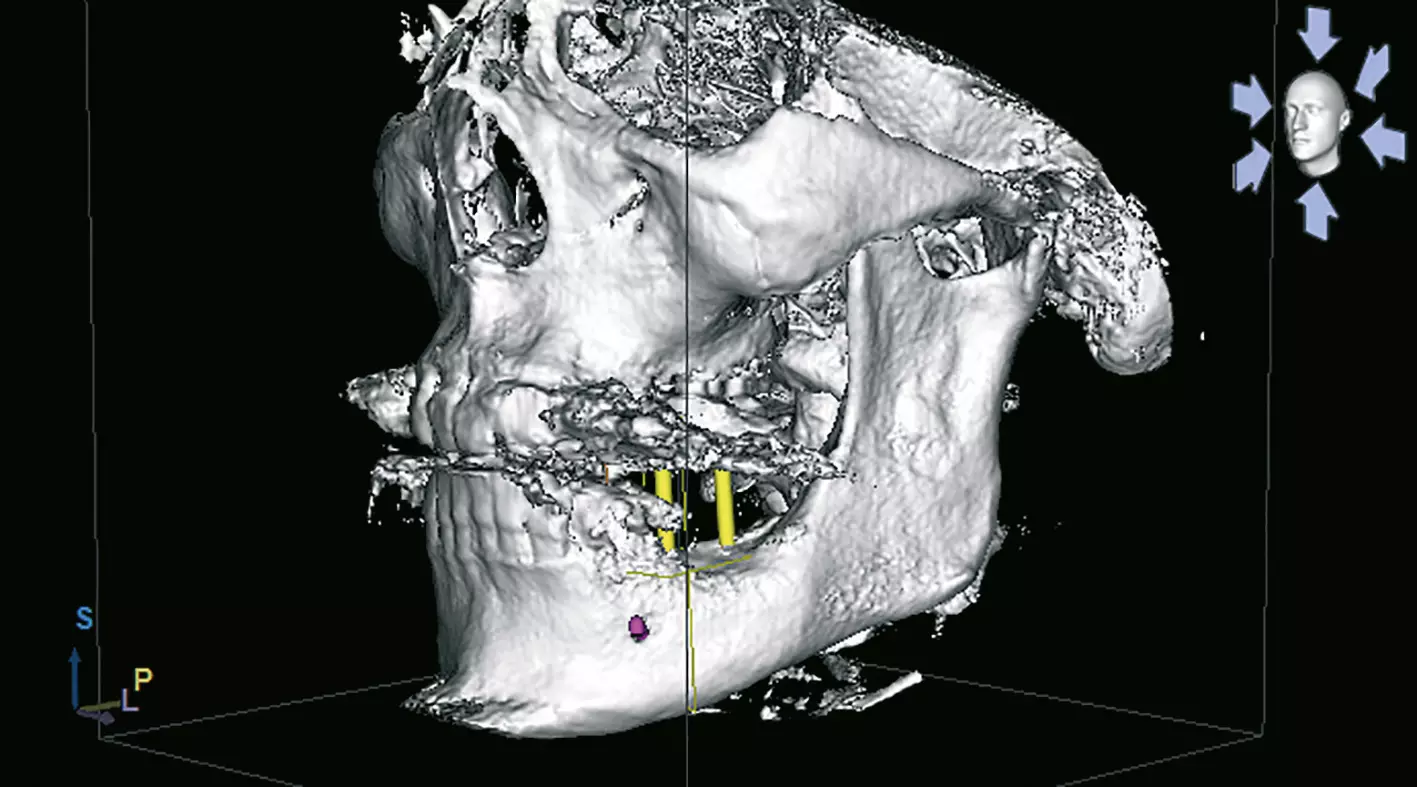 Abb. 3: Dreidimensionale Darstellung der Situation (CBCT-Aufnahme) in der Implantatplanungssoftware Simplant.