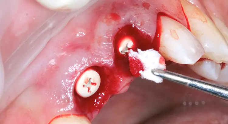 Abb. 3: Nach erfolgter subperiostaler tunnelierender Präparation Einbringung der porcinen Kollagenmatrix (Fibro-Gide®, Geistlich Biomaterials) in den bukkalen Bereich.