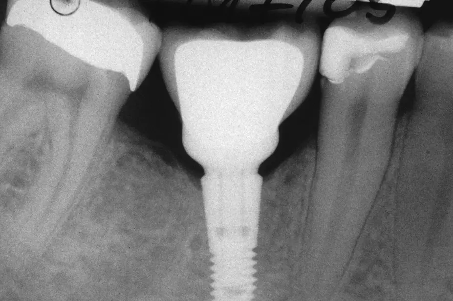 Abb. 3: Röntgenaufnahme regio 46 nach Eingliederung des Profile BiAbutments und Krone.