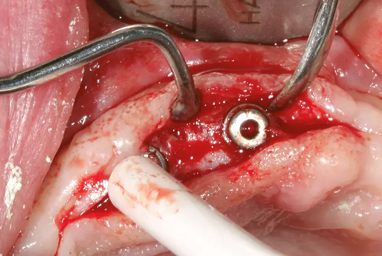 Abb. 3: Erzielter Knochengewinn von 4,5 mm nach dem Bonespreading-Prozedere unter Verwendung von patienteneigenem PRF.