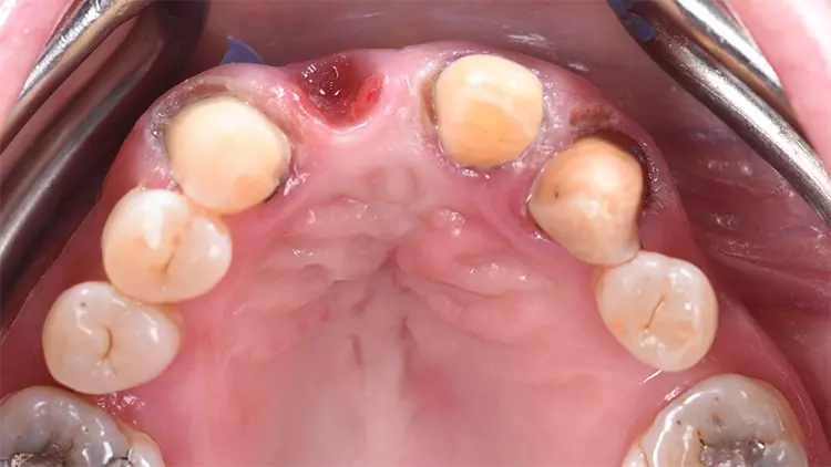 Abb. 3: Deutlich sichtbares oro-vestibuläres Volumendefizit in regio 11.