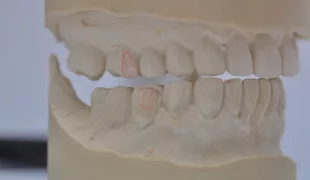 Schlussbiss gesperrt. Deutlich zu sehen ist, dass die Verzahnung suboptimal ist, was auch ein Grund für die vielen Chippings sein dürfte.