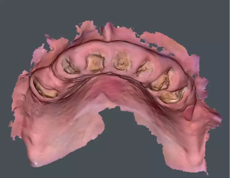 Abb. 3: Digitaler Abdruck der Ausgangssituation mit Hilfe eines 3D-Scans.