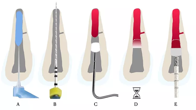 Abb. 3: Klinischer Ablauf einer Revitalisierung:
A: Nach bereits erfolgter Desinfektion des Wurzelkanals wird der Kanal initial
mit EDTA gespült und getrocknet.
B: Im nächsten Schritt erfolgt die Überinstrumentierung (z.B. mit einer
Hedströmfeile ISO 30), um eine Einblutung in den Kanal zu induzieren.
C: Anschließend wird ein Kollagenplug etwa auf Höhe der Schmelz-Zement-
Grenze platziert, um das Blutkoagel zu stabilisieren und ein Widerlager für den
hydraulischen Zement zu schaffen.
D und E: Nach einer Wartezeit von etwa 10 bis 15 Minuten kann der bioaktive
Zement gegen das Blutkoagel appliziert werden.